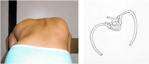 Fig. 4 a-b: Gibbo dorsale destro. Disegno schematico che mostra la rotazione dei corpi vertebrali alla base della deformazione della gabbia toracica