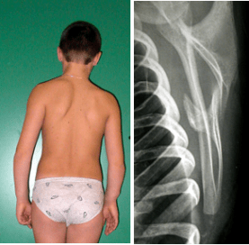 Fig. 4. Esostosi della faccia profonda della scapola, a contatto con la gabbia toracica.