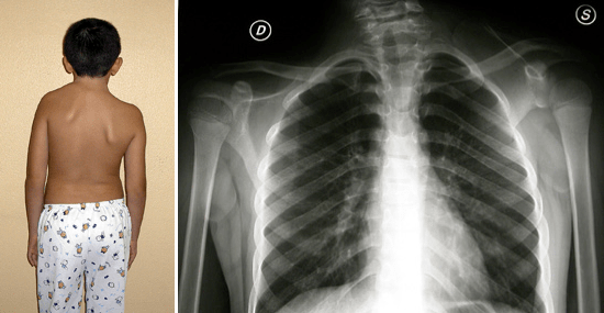 Fig. 5: Morbo di Sprengel, scapola alta congenita sinistra.
