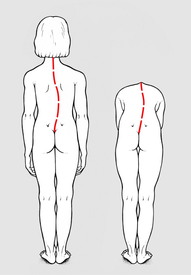 Atteggiamento scoliotico