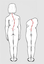 Fig. 2: scoliosi vera