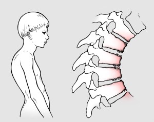 Fig. 1 Morbo di scheuermann