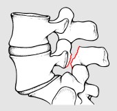 fig 2 spondilolistesi