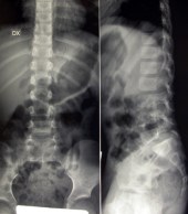 fig 5 spondilolistesi Rx