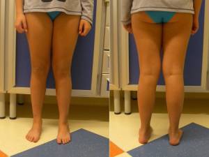 Fig 3.: ginocchio valgo essenziale